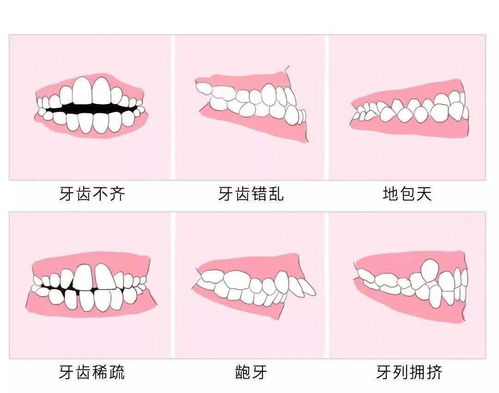 错颌畸形的病因学分类是什么