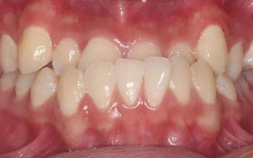 牙列不齐做矫治需要多长时间