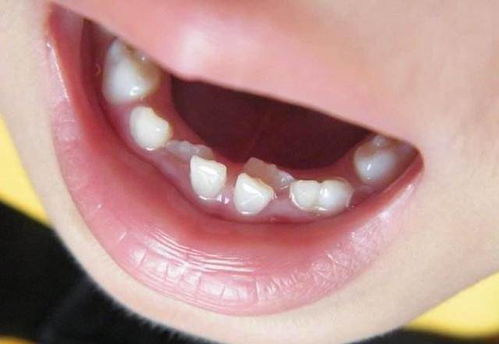 为什么儿童的口腔中会出现双层牙
