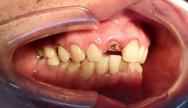 为什么牙齿缺失后应该镶牙