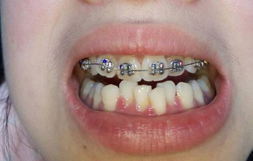 骨性错颌畸形的矫治是什么