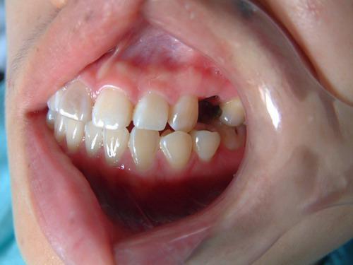 什么是固定义齿 有哪些种类和适应证