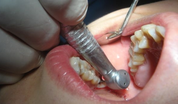 拔牙后多久镶牙合适