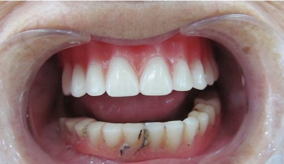 戴全口义齿可能发生什么问题 如何处理
