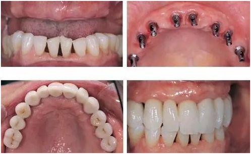 种植义齿有什么优点