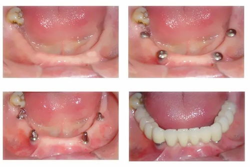 种植义齿成功的要素有哪些
