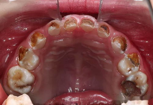 牙齿有龋应该立即治疗吗