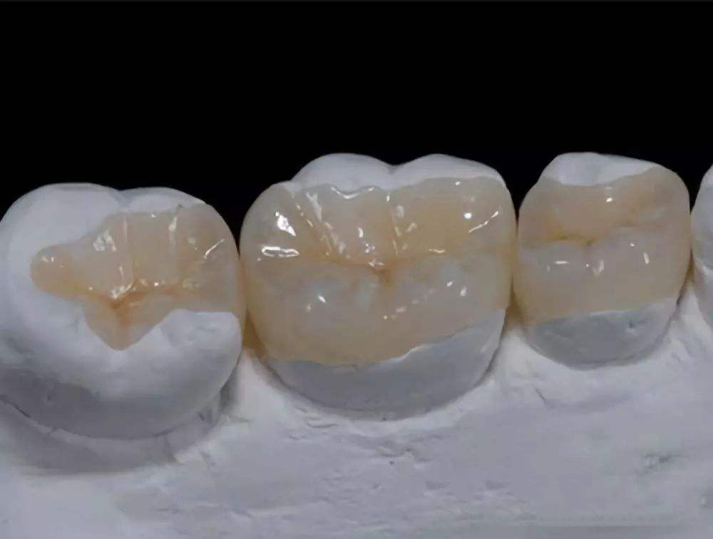 牙体缺损的嵌体修复