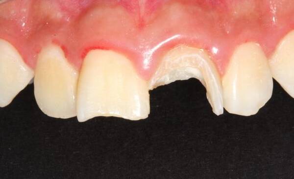 残冠残根的修复方法是什么