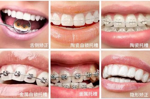 矫治器的性能及优缺点是什么