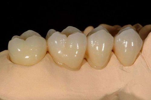 烤瓷牙是怎么回事