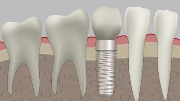 哪些人适合做种植牙