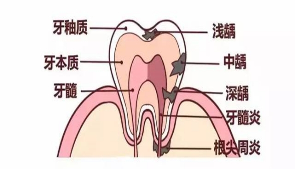 牙髓病的治疗原则是什么