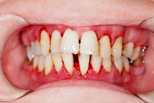 口腔正畸学与牙周病学的关系