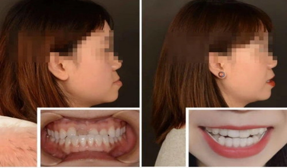 牙颌面畸形的正颌外科治疗是不是一做手术就能矫正畸形