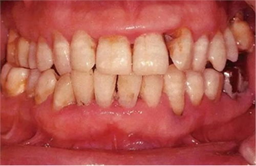 牙周病应该如何预防