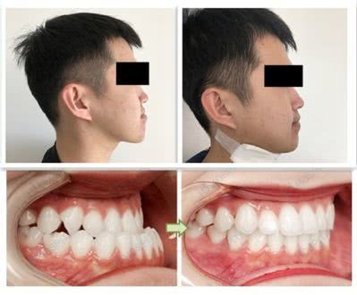 不可忽视儿童前牙“地包天”