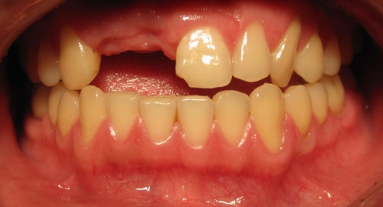 镶牙的时机是什么 镶牙的过程是什么