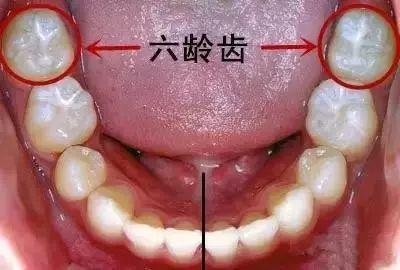 为什么要特别注意保护儿童“六龄牙”