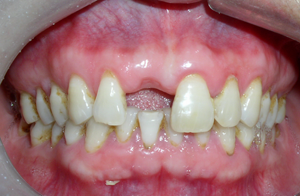 拔牙后不镶牙会有什么影响