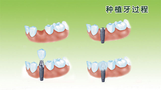 种植牙该如何维护
