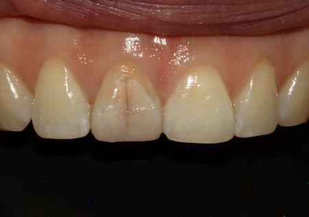 牙隐裂的病因是什么 牙隐裂有哪些临床表现