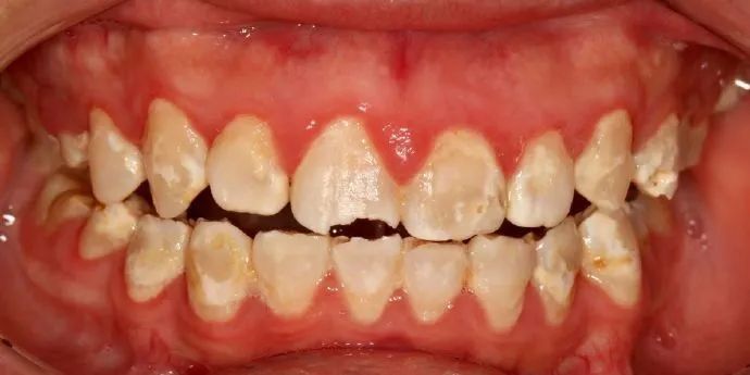 牙髓病的病因是什么