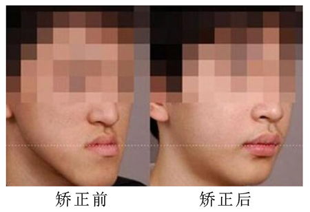 前牙反颌有哪些临床表现