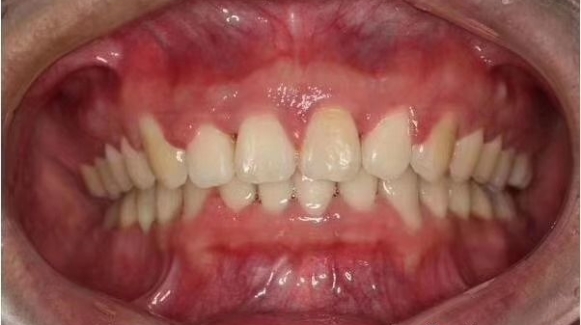 前牙深覆盖的病因是什么 前牙深覆盖有哪些临床表现