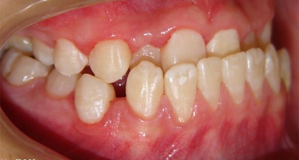 后牙反颌的病因是什么 后牙反颌有哪些临床表现