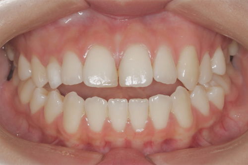 开颌的病因是什么 开颌有哪些临床表现