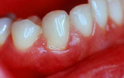 牙髓炎应该如何预防