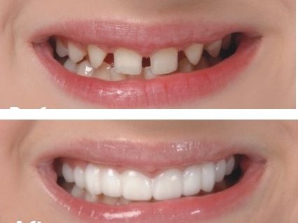 为什么说装假牙忌“贪便宜”