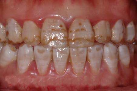 氟斑牙是什么