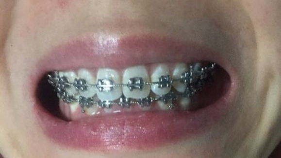 正畸治疗中的牙齿松动是什么