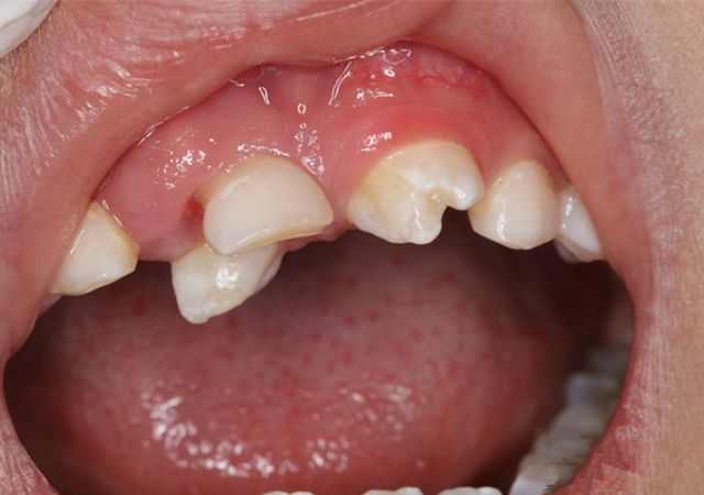 牙齿萌出异常怎么办