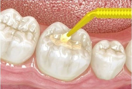 补牙后的注意事项有什么