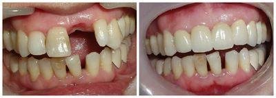 缺牙给身体带来哪些不良影响