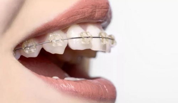 固定矫治器矫正牙齿有什么优缺点