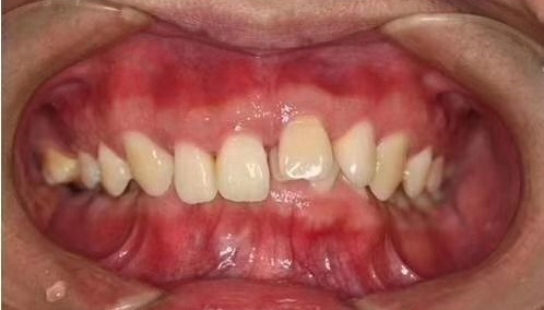 牙周病能进行正畸治疗吗