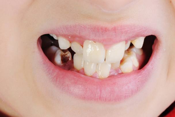 缺牙对身心有害吗