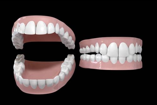 全口义齿需要怎么呵护