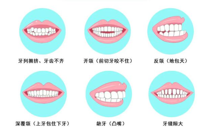 常见异常咬合与牙列不齐、错颌畸形的种类