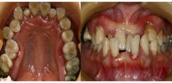 牙列拥挤的临床表现有哪些