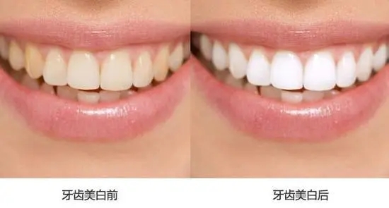 牙齿冷光美白是什么样的