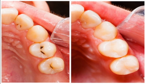 复合树脂牙体修复是什么样的