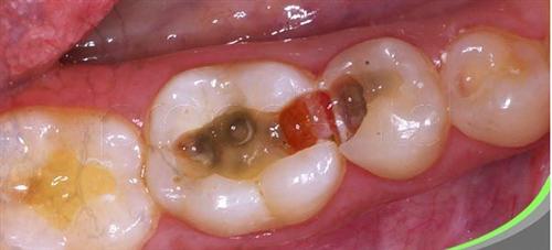 龋齿治疗都有哪些方法