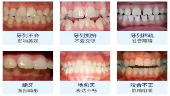 口腔正畸有哪几种方式