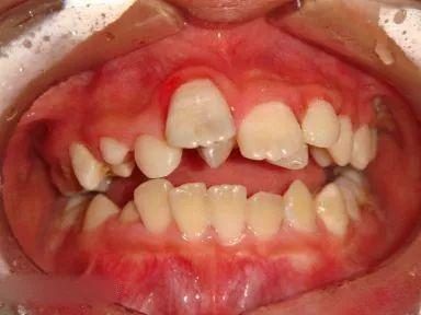 牙齿排列不整齐就容易患龋齿吗