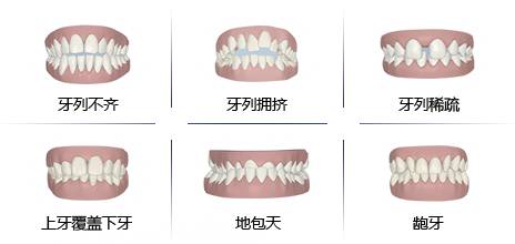 错颌畸形的特征有哪些